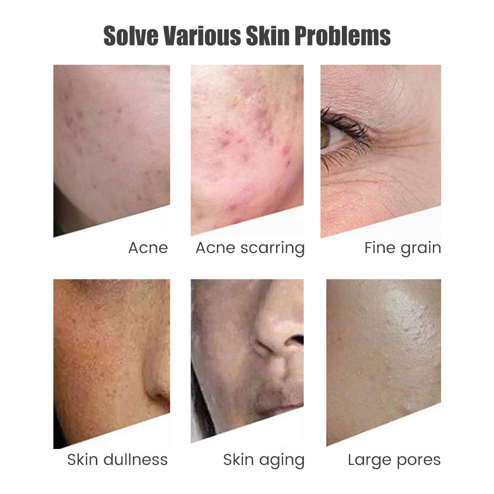 SUOLAER Derma Pen – Profesjonell Microneedling for Hudfornyelse og Anti-Aging