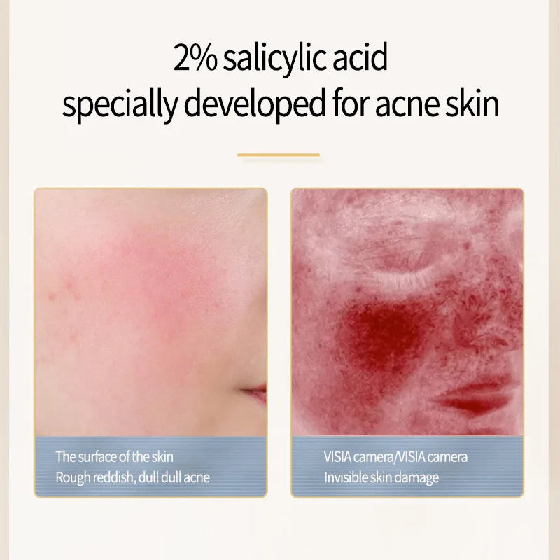 ClearSkin Salicylic Serum – Mot Akne, Arr & Store Porer