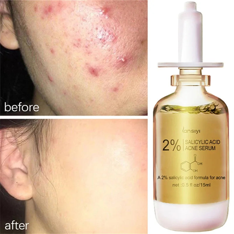 ClearSkin Salicylic Serum – Mot Akne, Arr & Store Porer