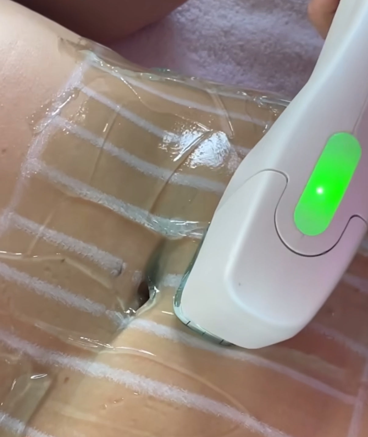 H-022 HIFU – Profesjonell facelift, fettfjerning og Anti-Aging teknologi hjemme