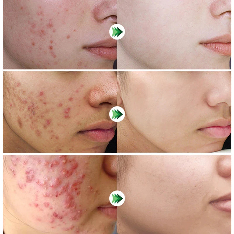 ClearSkin Salicylic Serum – Mot Akne, Arr & Store Porer
